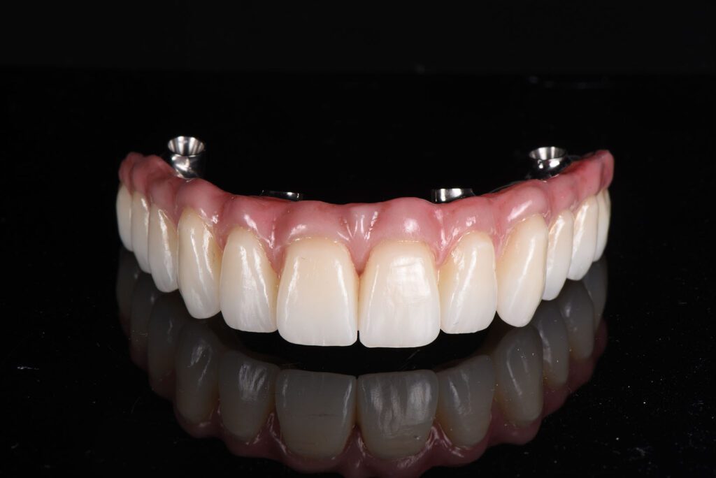 dental implants Warrington